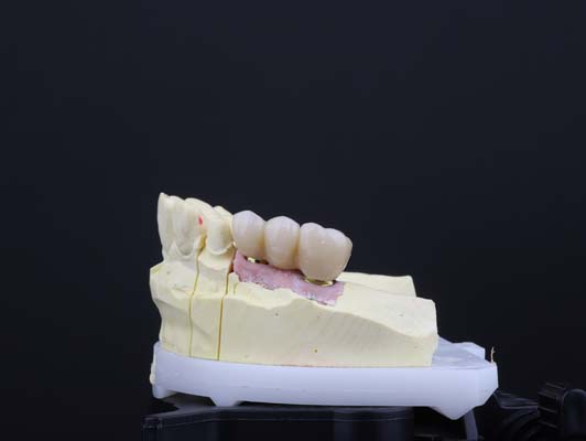 How Dental Bridges Can Improve Your Smile
