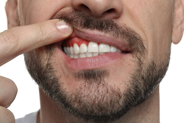 How Gum Disease Treatment Restores Oral Health And Confidence