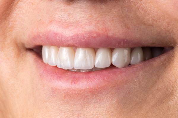 Bring Back A Stronger Smile With Implant Supported Dentures