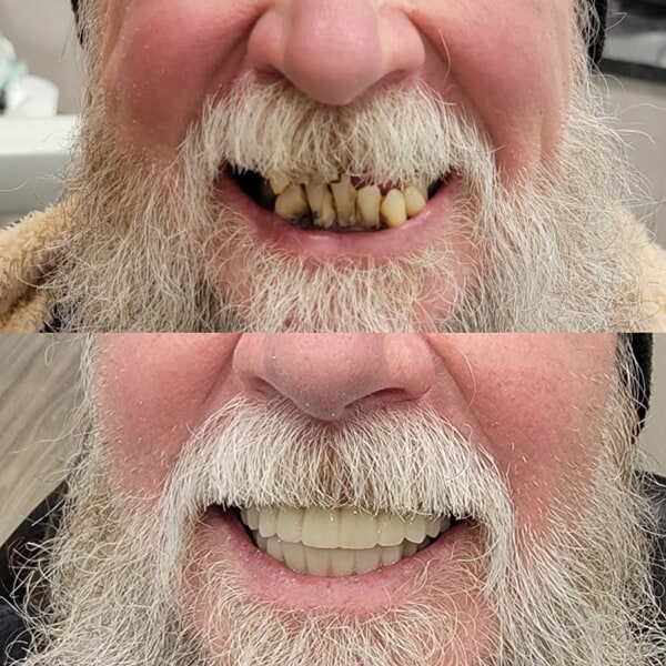 Implant-Supported Dentures