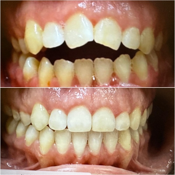 Invisalign