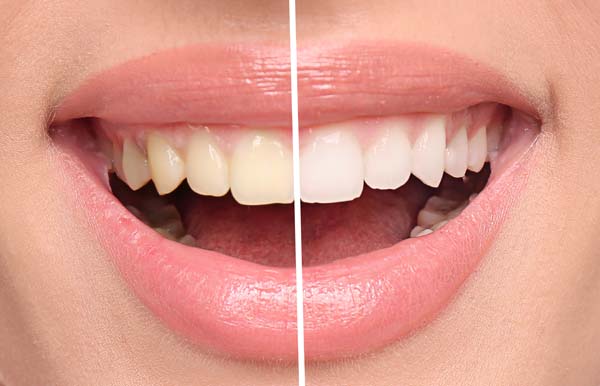 Types Of Teeth Whitening