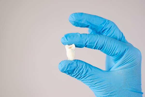 Who Needs A Wisdom Tooth Extraction